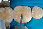 Figure 19  Adjustments were made to the occlusal surface initially with an egg-shaped carbide bur on high dry.