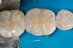 Figure 20  Before final polishing, the lower right second molar was restored with an occlusal composite using Aelite enamel A1.