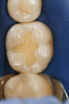 Figure 2  After anesthetization, rubber dam isolation was achieved and the amalgam was removed.