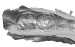 Fig 7. The opposing arch is actually coming through the lower teeth, throwing off the bite scan.
