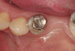 Figure 1  Preoperative view of a root canal-treated tooth with a failing amalgam core.