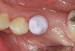 Figure 4  Occlusal view of the IPS e.max CAD lithium-metasilicate (“blue stage”) crown during try-in.