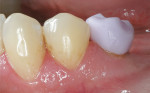 Figure 5  Buccal view of the IPS e.max CAD lithium-metasilicate (“blue stage”) crown during try-in.
