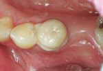 Figure 6  Occlusal view of the fired IPS e.max CAD lithium-disilicate crown inserted using the transparent shade of SpeedCEM cement.