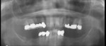 Figure 12a  A 65-year-old female with a bilateral partially edentulous mandible.Treatment planned for implant placement with immediate loading. Preoperativepanoramic radiograph.