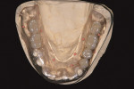 Figure 12b  Radiographic guide,mandible.