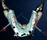 Figure 12c  Next, the virtual treatment plan, occlusal view, NobelGuide <strong>(C)</strong>. Model with stone removed posteriorly,implant analogs secured bilaterally in NobelGuide <strong>(D)</strong>. Provisional restoration with internal titanium