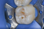 Fig 6. Conservative cavity preparation. Note minimal removal of enamel, allowing access to remove the caries lesion.