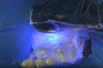 Fig 13. After second increment of resin composite was applied and not light-cured, the occlusal matrix was installed and the restorative material light-cured for 10 seconds.