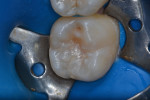 Fig 16. Note the precise occlusal anatomy of the final restoration with no occlusal adjustments needed.