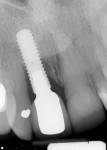 Radiographic situation at routine maintenance
demonstrating severe peri-implant
bone loss, along with mesial attachment
loss on tooth No. 7.