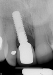 Radiograph taken 14 months post-surgery demonstrates a significant amount of bone regeneration. Proximal bone levels are preserved on tooth No. 9 and improved on tooth No 7. Although threads remain above the bone level on tooth No. 8, several millimeters of implant surface have been re-osseointegrated.
