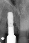 The overlying flap is closed with
reservable sutures. No tension is present to
achieve repositioning of the soft tissue to its
preoperative position. A postoperative radiograph is used to establish baseline bone graft levels.