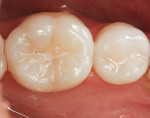 Figure 1  Tooth No. 19 demonstrated signs of decay under an old sealant restoration.