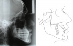Fig 3. Pretreatment lateral cephalometric radiograph with tracing.