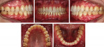 Fig 21. Intraoral photographs 4 years post-treatment showing a very stable occlusion.