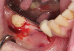 An incision is made lingual to the crest to preserve approximately 3 mm of attached gingiva, which will be adapted to the buccal aspect of the implant site.