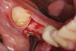 The lingual attached gingiva is left intact while the flap with the band of attached gingiva is elevated to the buccal. Adequate bone height and width is present to accept the implants.