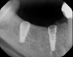 A radiograph illustrates that the position of the implants on the crest of the ridge respects the vital anatomy.