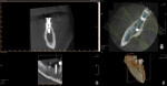 Postoperative CBCT analysis illustrates the ideal position of the implants in the edentulous mandibular second bicuspid and first molar areas.