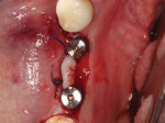 The 3 mm band of exposed bone lingual to the healing abutments is left unclosed to heal through secondary intention.