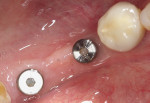 After approximately 4 months of integration, the gingival tissue around the healing
abutments demonstrates a lack of inflammation, and the incision gap left at surgery
is filled and covered with attached keratinized gingiva.