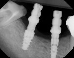 A digital radiograph was taken to ensure that the metal components were completely seated.