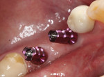 Impression copings were placed to engage the inside components of the implants.
