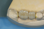 A master cast was created; custom abutments, which engage the internal design of the implants, were prepared; and individual
Bruxzir zirconia crowns were fabricated.