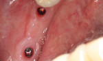 The healing abutments were again removed, revealing healthy pink gingiva around the
implants.