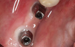 The prepared custom abutments were then inserted into the implants and torqued to 35 Ncm. Note that the margins are prepared
at the gingival height of contour to prevent the potential for periodontal problems resulting from excess cement being pushed subgingivally.