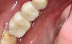 The final implant-retained crowns are cemented into place.