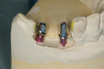 The impression was captured with
conventional impression techniques using medium and heavy body Panasil vinyl polysiloxane material. Then, the implant transfer assemblies were threaded into the lab analogues and inserted into the final impression.