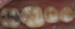 Postoperative view of tooth No. 30.