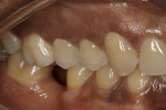Postoperative view of tooth No. 4.