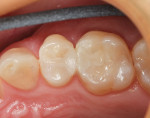 Figure 12  The 1-day postoperative view of the adjacent Class II resin restorations.