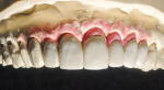 Fig 4. A wax-up was fabricated to correct the tooth size and form and replace the lost gingival tissues.