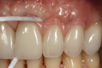 Fig 15. The proximal surfaces of the pink veneers were easily cleaned with floss tape.