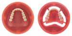 Fig 7. Merz Dental Baltic Denture System® preformed complete denture pucks.