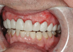 Figure 8  The provisionals immediately after treatment; the result of the soft tissue recontouring is evident.
