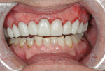 Figure 9  The provisionals immediately after treatment; the result of the soft tissue recontouring is evident.
