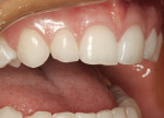 Figure 2  Lateral view shows short incisors with a slight lingual inclination. The patient’s smile shows the lingual inclination of the maxillary teeth and the minimal lip support.