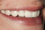 Figure 6  The patient’s smile demonstrates how the veneers created a full smile with the addition of facial volume to the teeth.