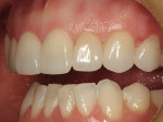 Figure 10  A retracted lateral view shows that even after only 48 hours, the soft tissue has responded well to the no-prep veneers.