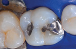 Preoperative view of the occlusal surface.