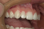 Figure 12  The lateral view shows the undersized lateral incisors and the wide, broad incisal embrasures.