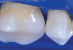 Preoperative and postoperative views demonstrating the ideal rounded embrasures created with the Biofit Matrix System.
