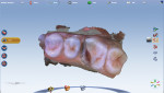 Digital model of prepared tooth No. 14, acquired with the Planmeca Emerald intraoral scanner.