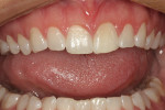 Figure 19  Postoperative photograph 1 month after completing the gingivectomy.