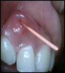 Fig 1. Tracer radiographic examination revealed the origin of gutta-percha in the apical end of an invagination with respect to tooth No. 7.